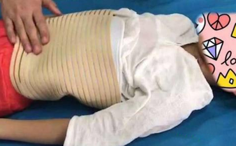 胸椎或腰椎二椎体以上压缩性骨折